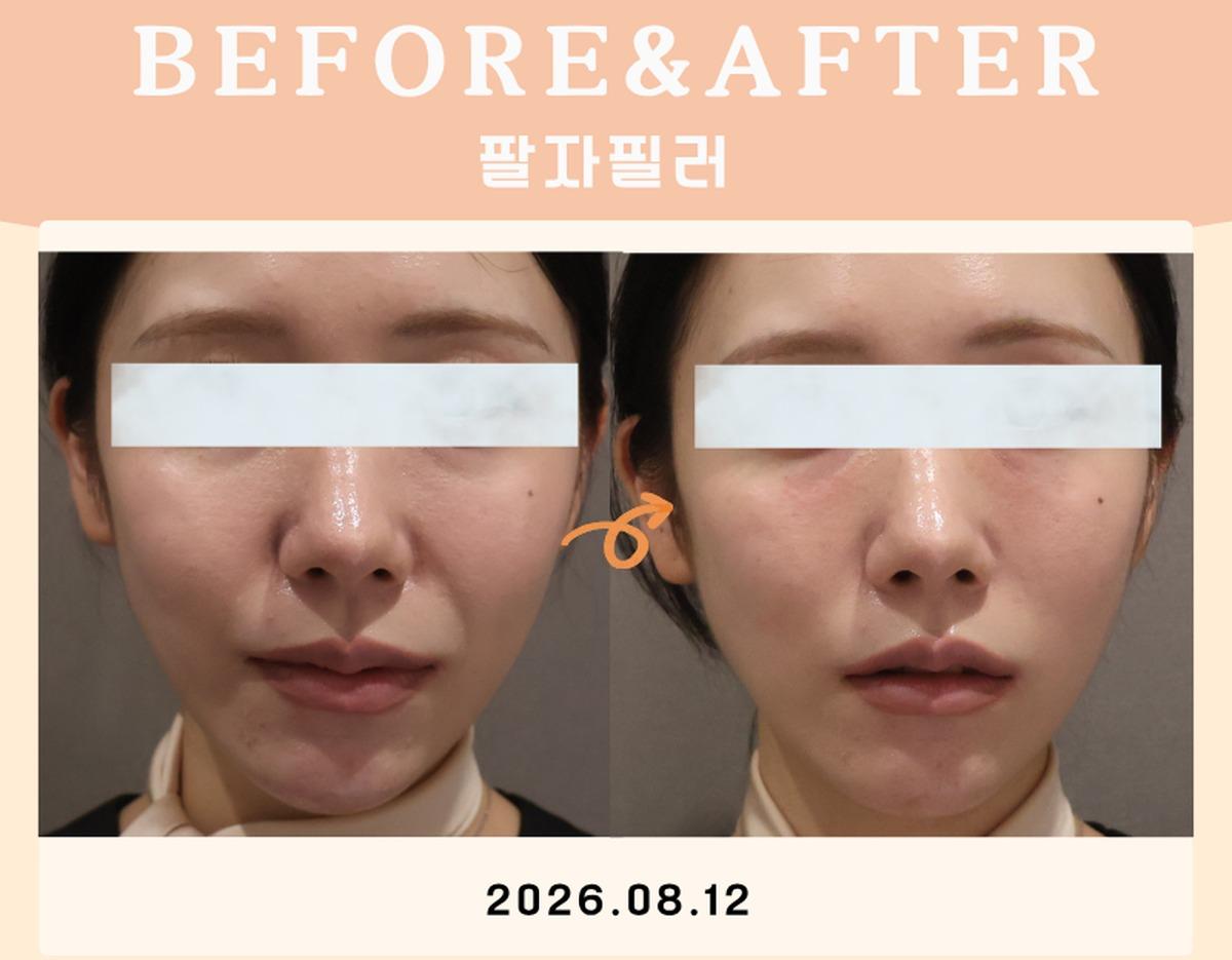 Before-and-after example