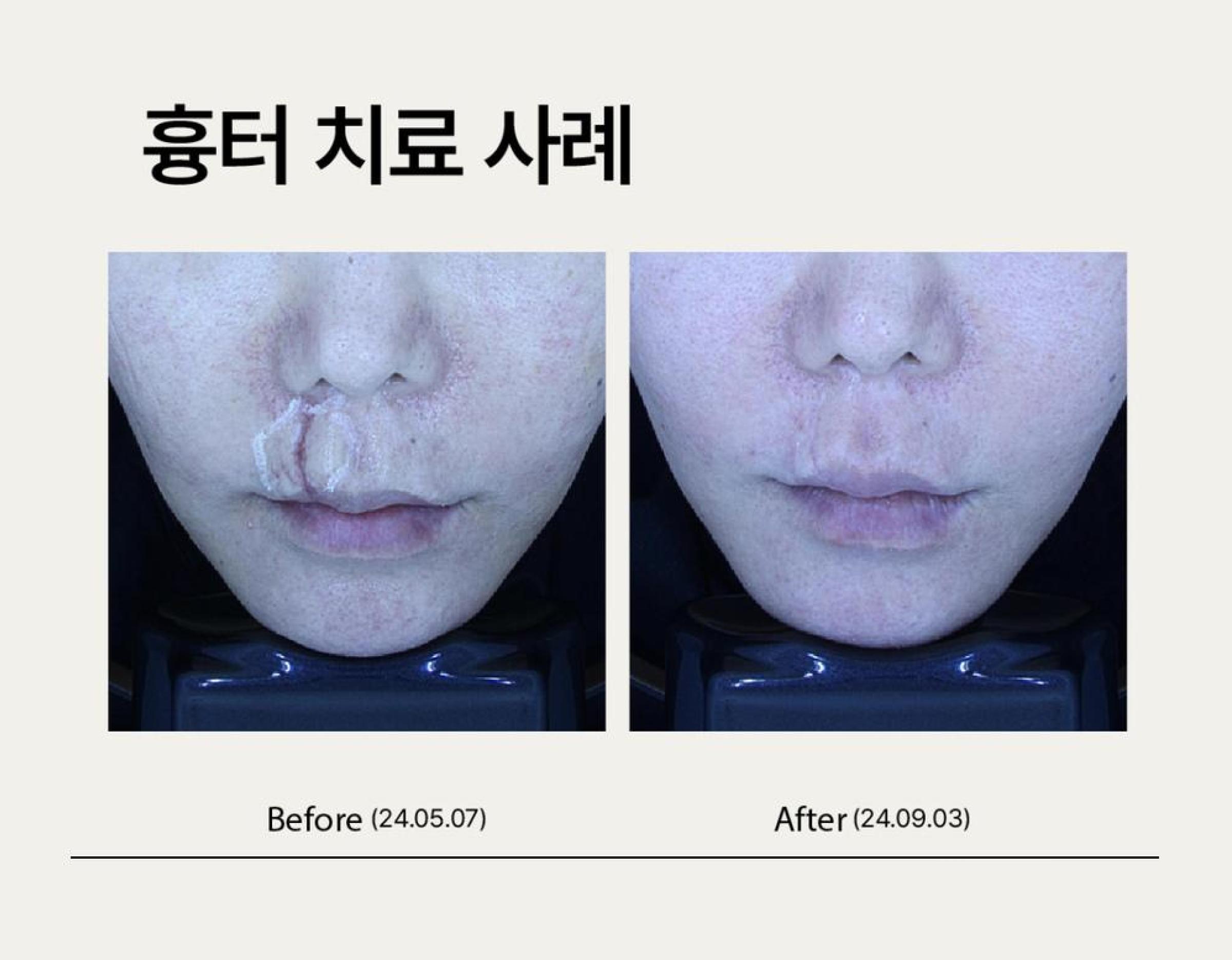 Close-up photos of the upper lip and philtrum before and after scar treatment