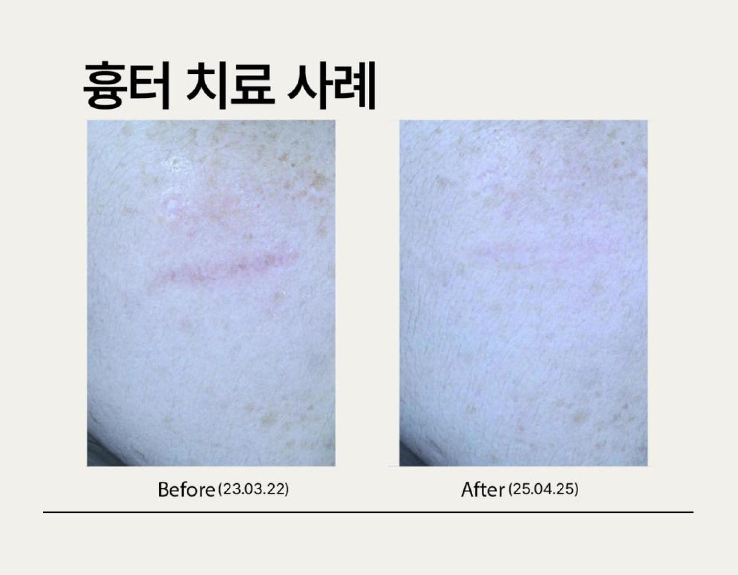 Close-up photos of a linear skin scar before and after treatment
