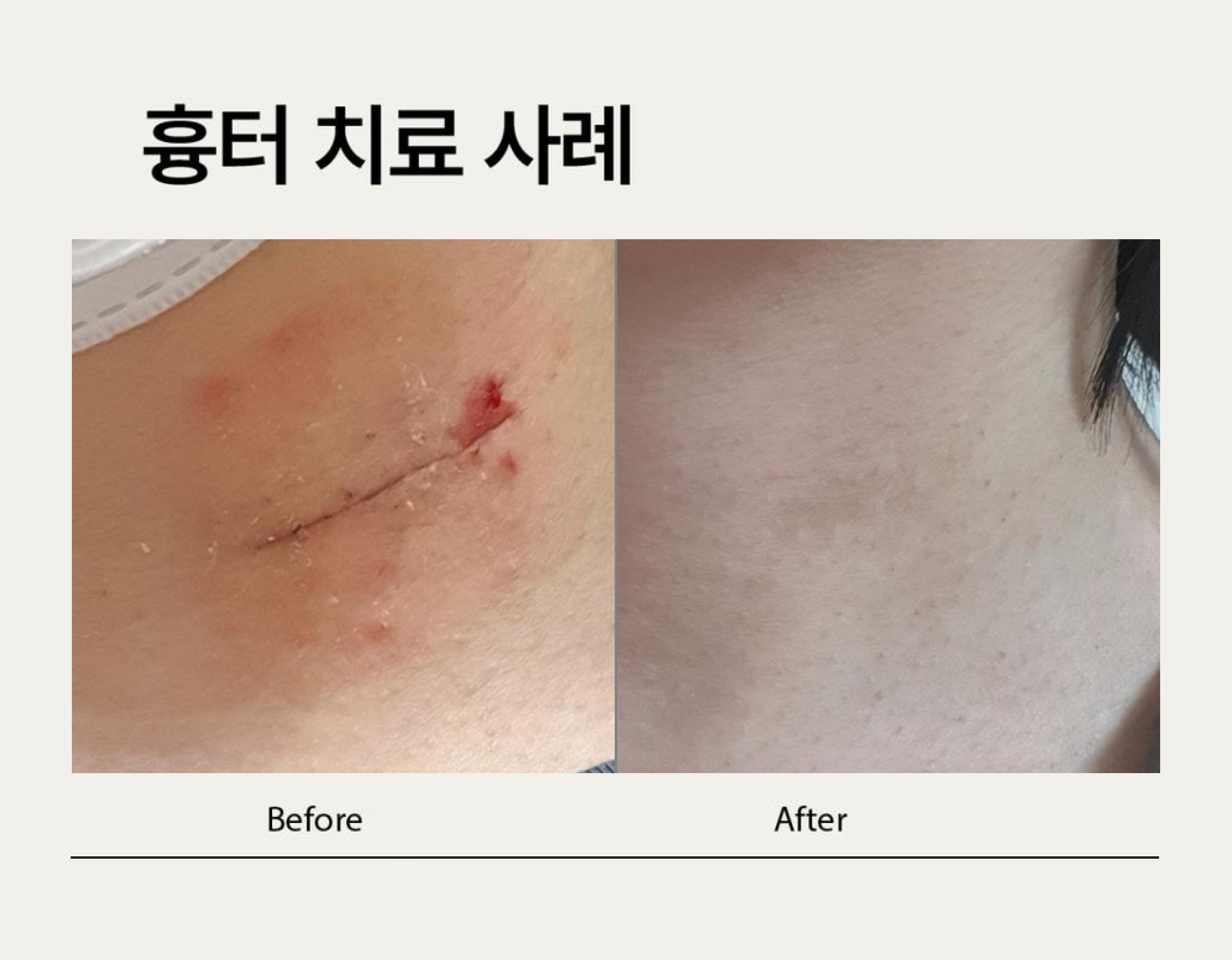 Neck wound and scar photos before and after treatment