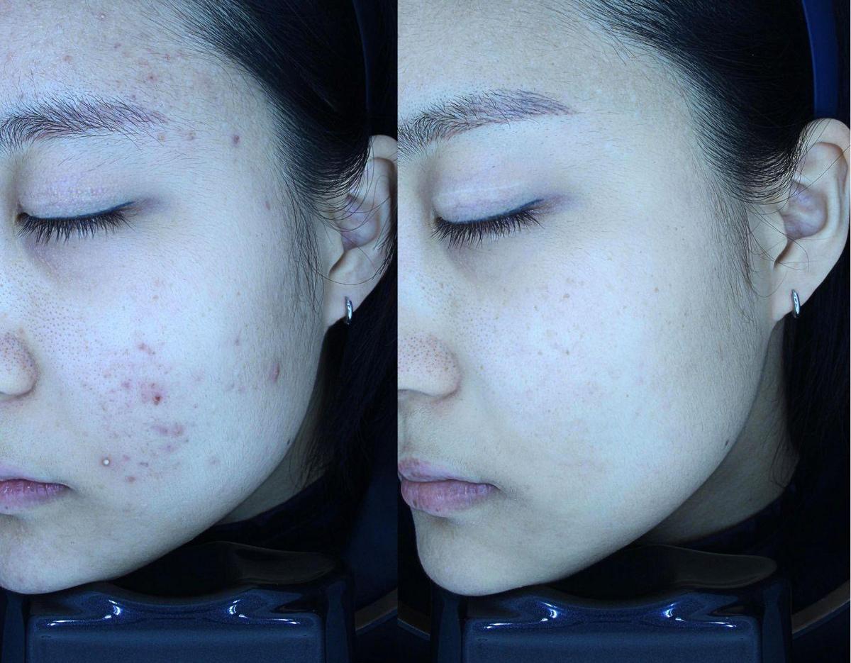 Side-by-side cheek photos before and after scar treatment