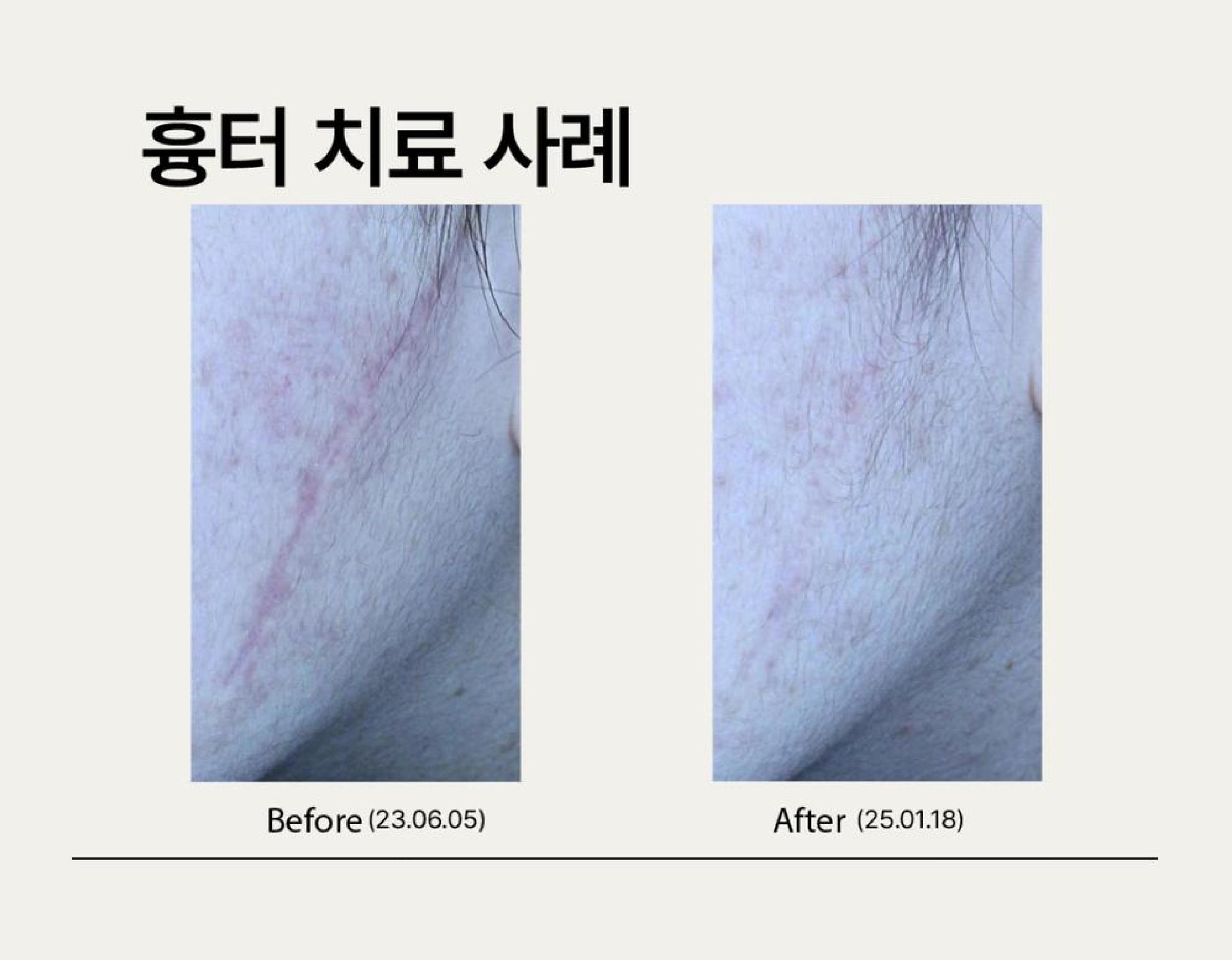 Cheek scar photos before and after treatment