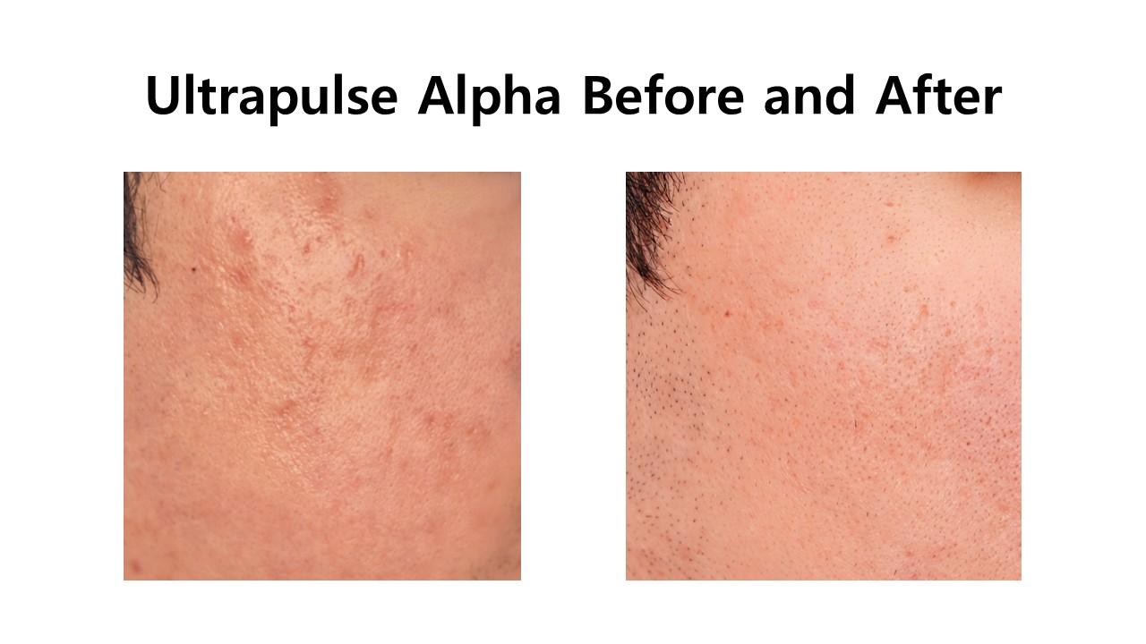 Ultrapulse Alpha before and after example