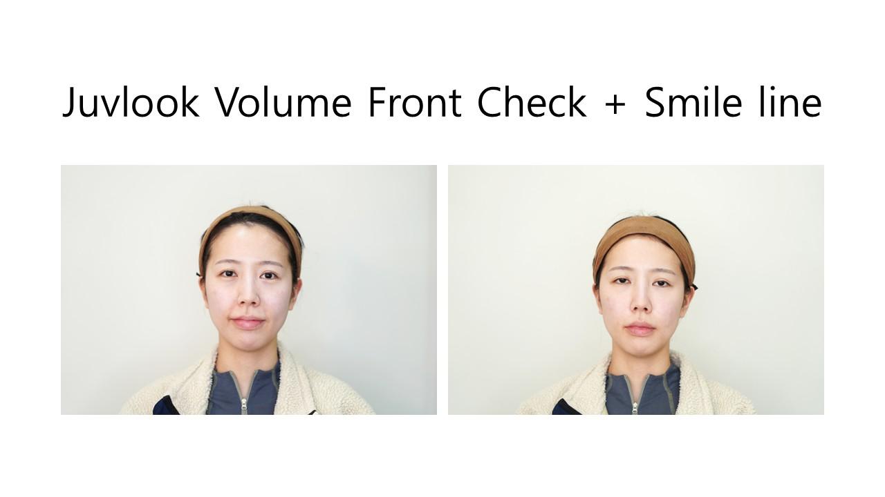 Juvlook Volume Front Cheek + Smile Line before and after example