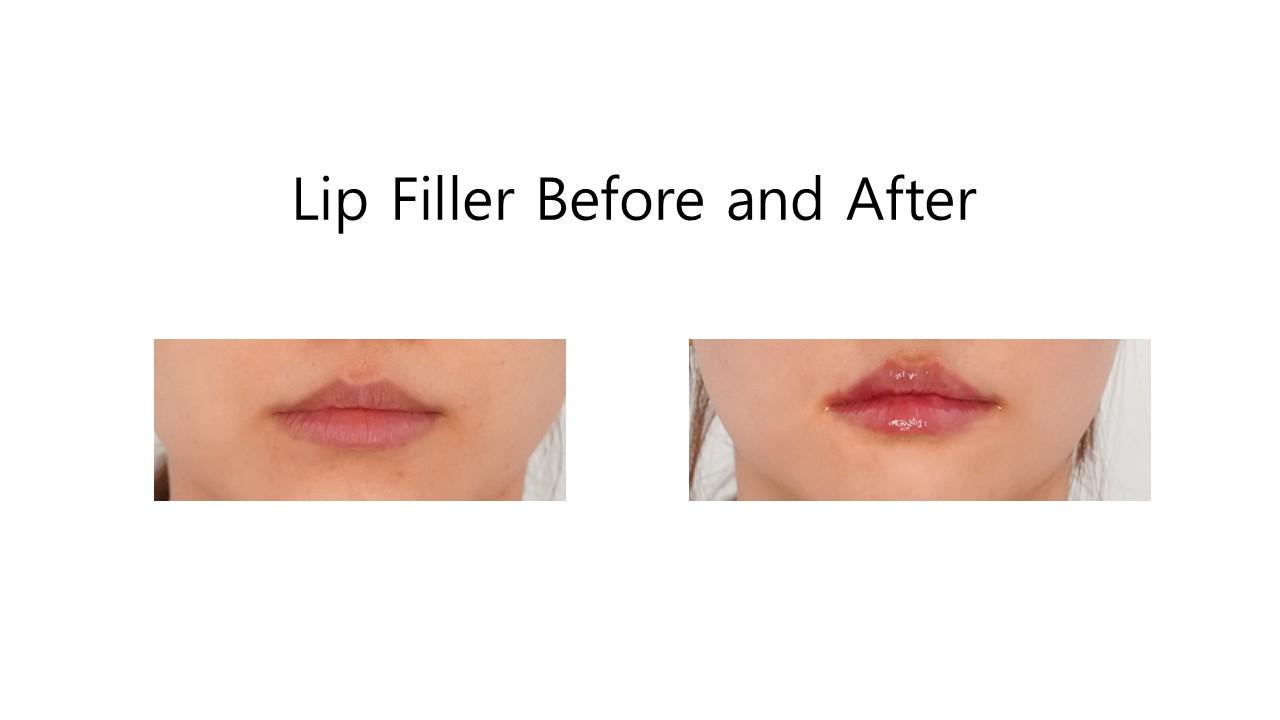 Lip Filler before and after example