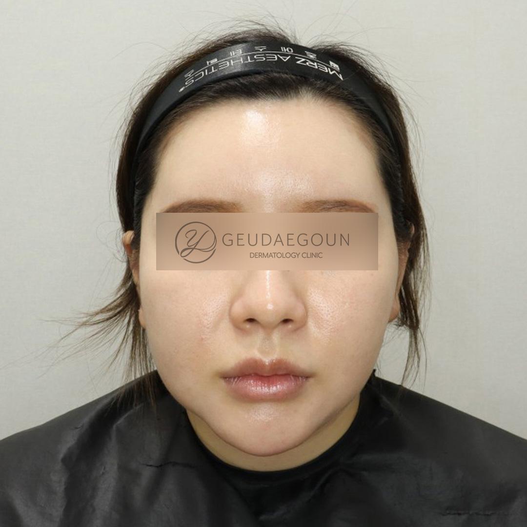 Antes del tratamiento Ulthera + Thermage