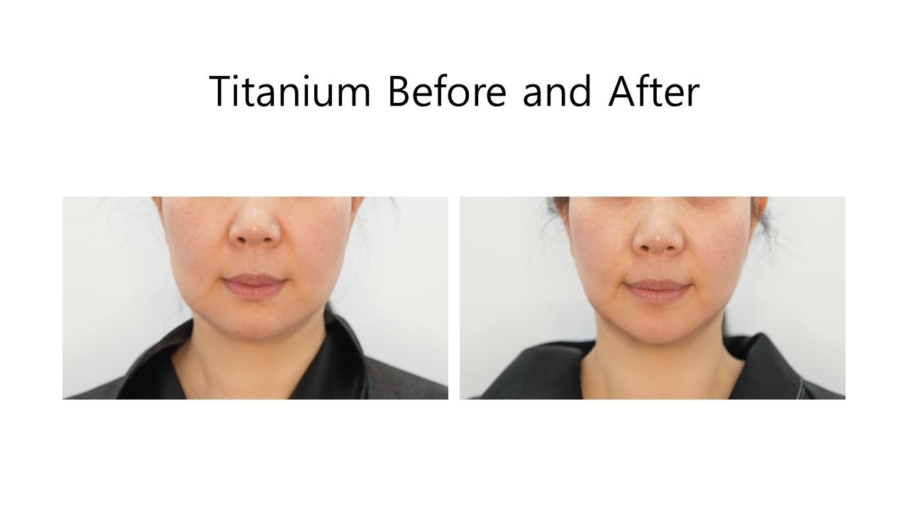 Titanium before and after example