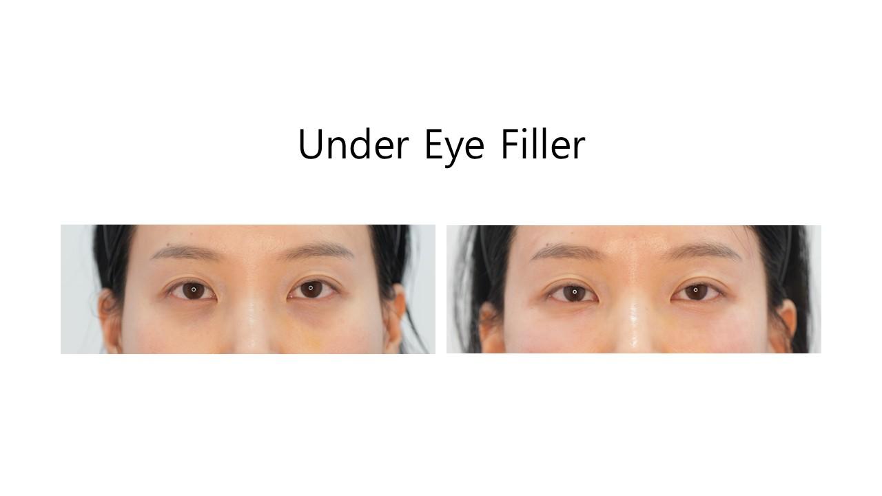 Under Eye Filler before and after example