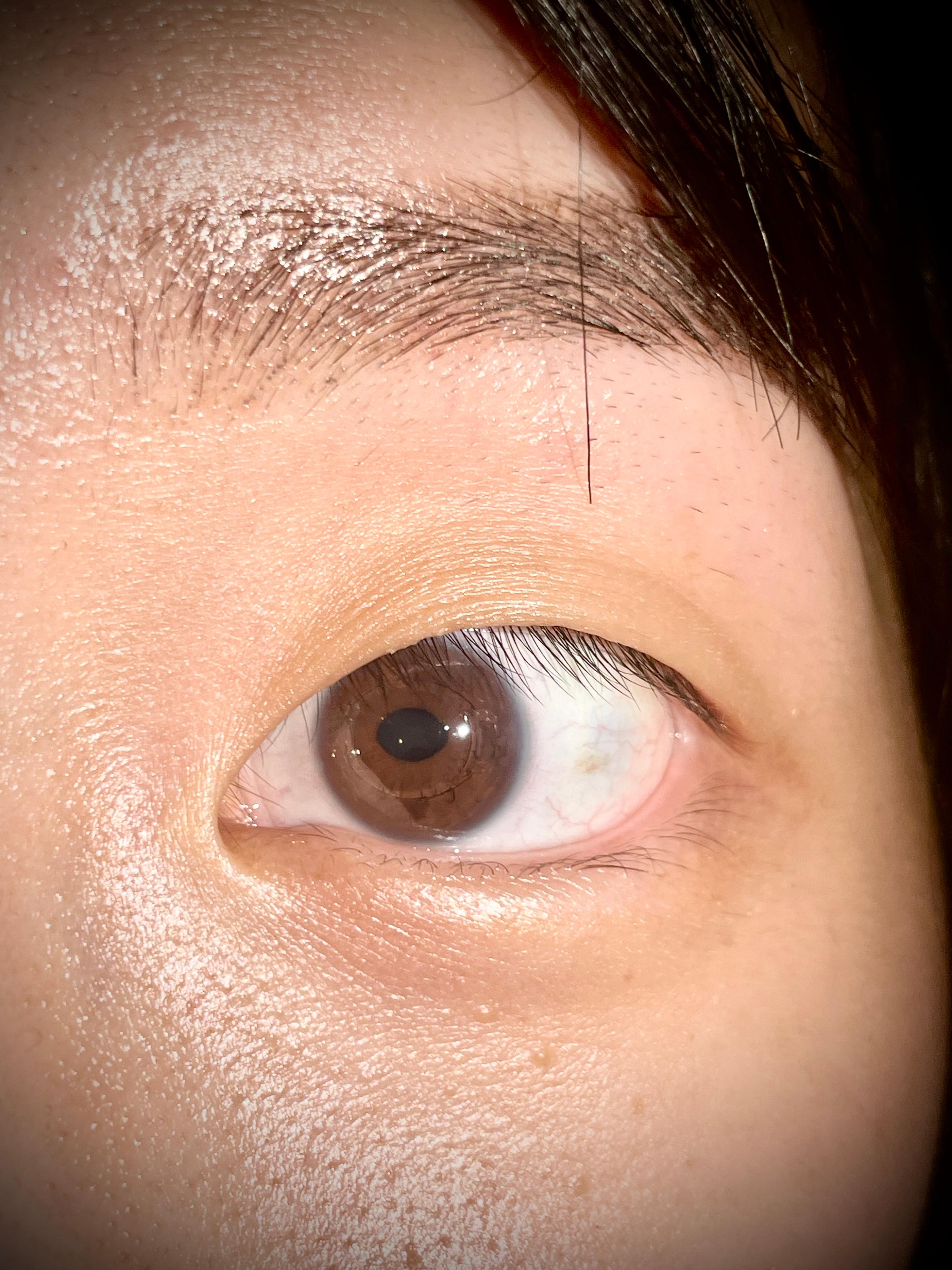 👀 #ICLJourney | Finally goodbye to high myopia!